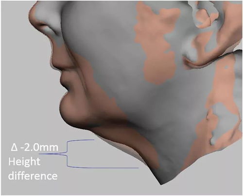 3d成像評估注射溶脂 冷凍溶脂后頦下脂肪消除情況